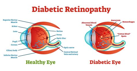 Diabetic Retinopathy Explained