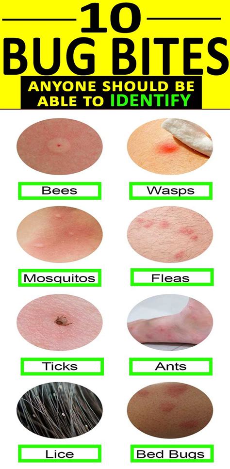 A Good Remedy For Bed Bug Bites | Health Info - Bed Bugs