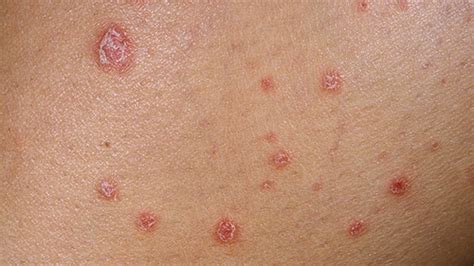 Psoriasis: Symptoms, Causes and Treatment - Avens Blog | Avens Blog