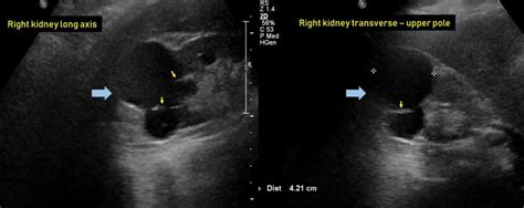 Ultrasound features of Kidney Cysts - Renal Fellow Network