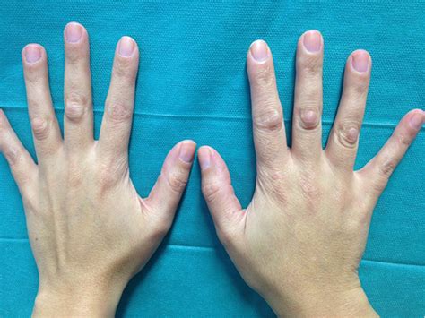 RACGP - Enlarging knuckle bumps