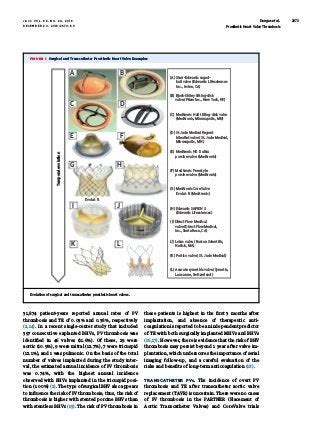 Prosthetic Heart Valve Thrombosis | PDF