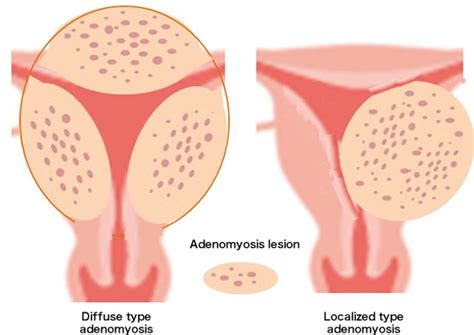 Obstetrics and Gynecology Disease：Leiomyoma / Endometriosis ...