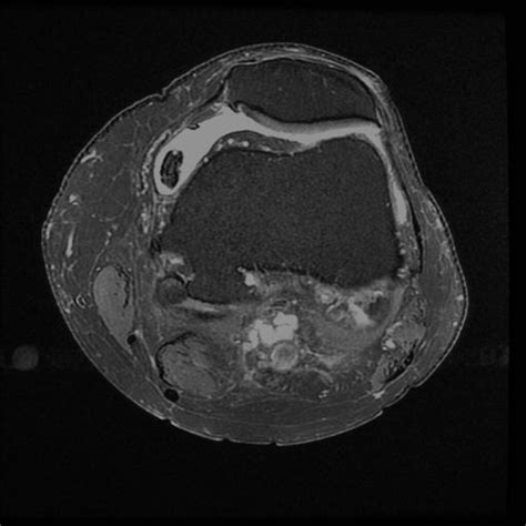 Medial Osteochondral Loose Body | Knee MRI