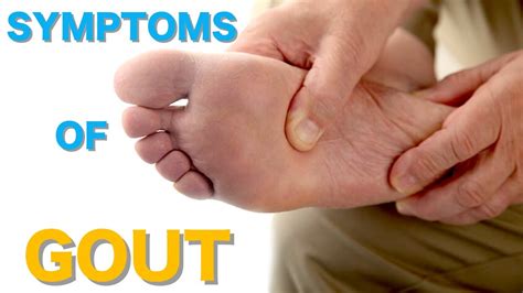 Top 10 Common Gout Symptoms Causes of Gout Symptoms of Gout - YouTube