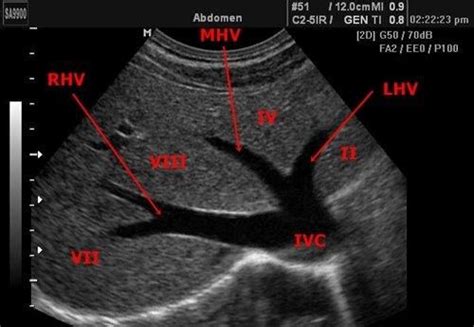 http://cardiodximage.com/wp-content/uploads/2013/07/Liver_Segments ...