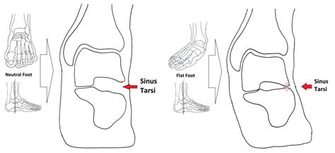 Sinus Tarsi Pain (Sinus Tarsi Syndrome) - Ankle, Foot and Orthotic Centre