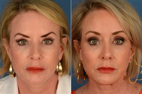 Eyebrow & Forehead photos - Aesthetic Surgery Center