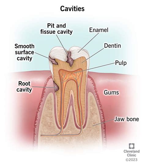 Cavities (Tooth Decay): Symptoms, Causes & Treatment