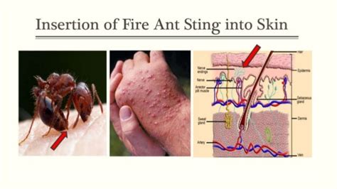 Fire ant stings: pathophysiology and natural remedy