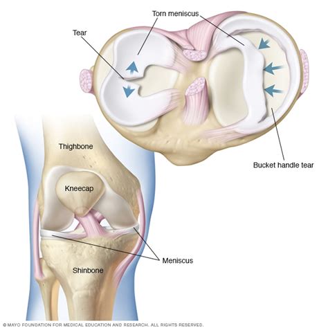 Torn meniscus - Symptoms & causes - Mayo Clinic