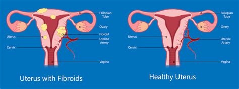 Uterus Cancer Signs