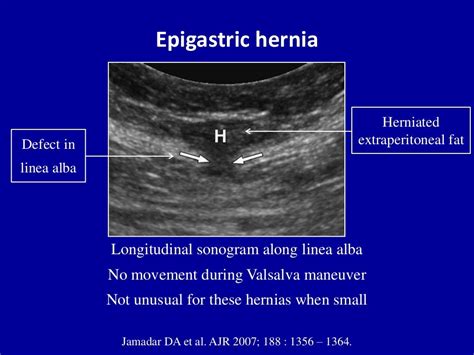 Ultrasound of the abdominal wall hernias