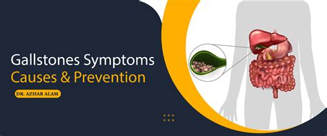 Gallstones Symptoms, Causes, Prevention | Gallstone Specialist