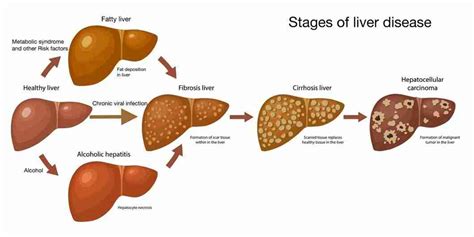 Liver Cirrhosis: Symptoms, Causes, Stages, Treatment & Prevention