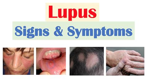 Lupus Signs & Symptoms (& Why They Occur) | Skin, Joints, Organ Systems ...