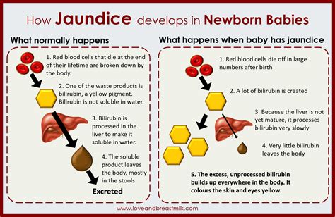 jaundice infographic | Newborn nursing, Pediatric nursing, Neonatal nurse