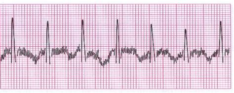 electrical-interference - Cardiac Sciences Manitoba