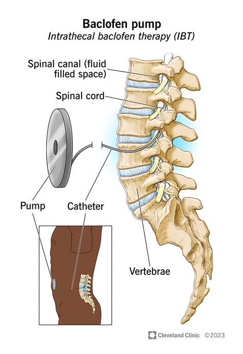 Baclofen Pump: What It Is, Side Effects & Complications