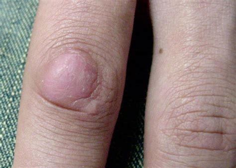 VARIOUS or of UNKNOWN ETIOLOGY DISEASES - Knuckle Pads picture ...