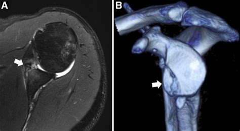 Arthroscopic Anterior Shoulder Stabilization With Incorporation of a ...