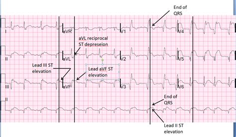 Dr. Smith's ECG Blog: Subacute AnteroSeptal STEMI, With Persistent ST ...