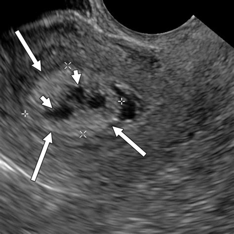 Gynae Ultrasound Flashcards | Quizlet