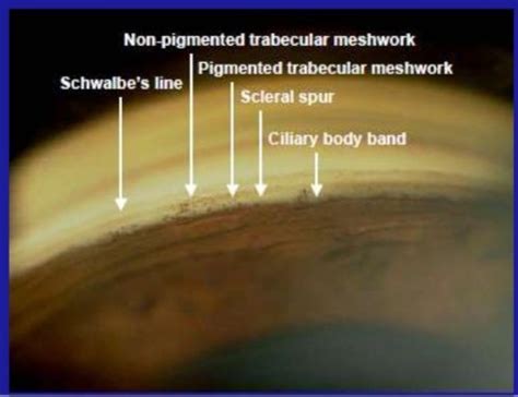 Anterior Chamber Gonioscopy Flashcards | Quizlet