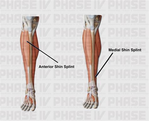 SHIN SPLINTS | PHASE - IV