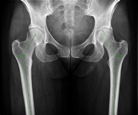 normal femur x ray - Google 搜尋 | X ray, Painting, Radiology