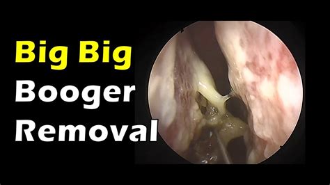 Giant booger removing - YouTube