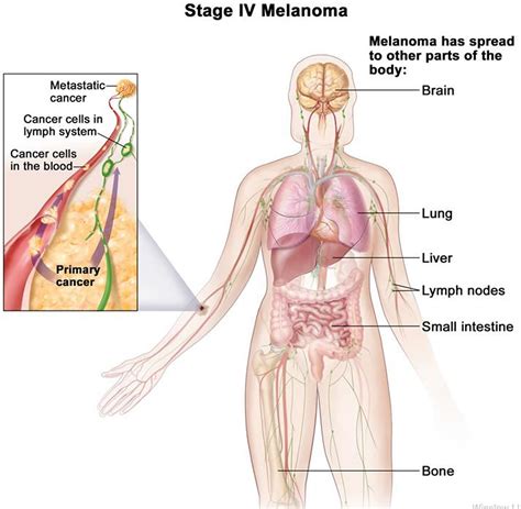 Metastatic stage 4 melanoma, life expectancy & metastatic melanoma ...