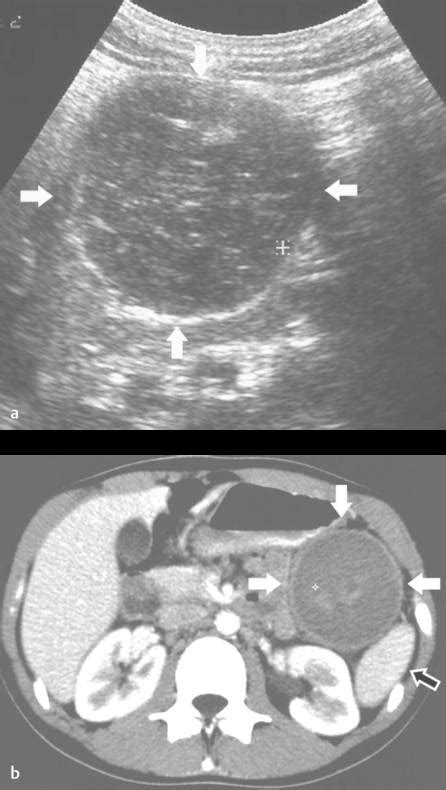 10 Spleen | Radiology Key