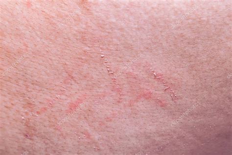 Abrasion wound on the skin from scratching. — Stock Photo © SanchaiRat ...