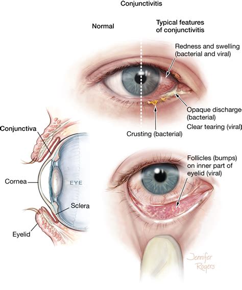 Conjunctivitis | External Eye Disease | JAMA | The JAMA Network