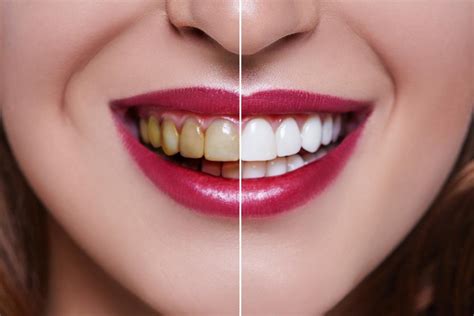 The Benefits of a Deep Cleaning Treatment For Your Teeth and Gums When ...