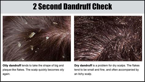 Do you have dandruff or just a dry scalp? - Global Village Space