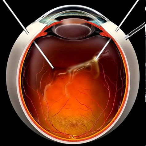 Pars Plana Vitrectomy Defined