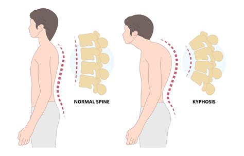 Kyphosis: Definition, Causes, Symptoms, Diagnosis, Treatment, and ...