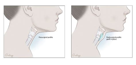 Adam’s Apple Surgery – Augmentation via Natural Implant for FTM Facial ...