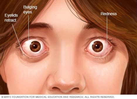 Thyroid eye disease - Mayo Clinic