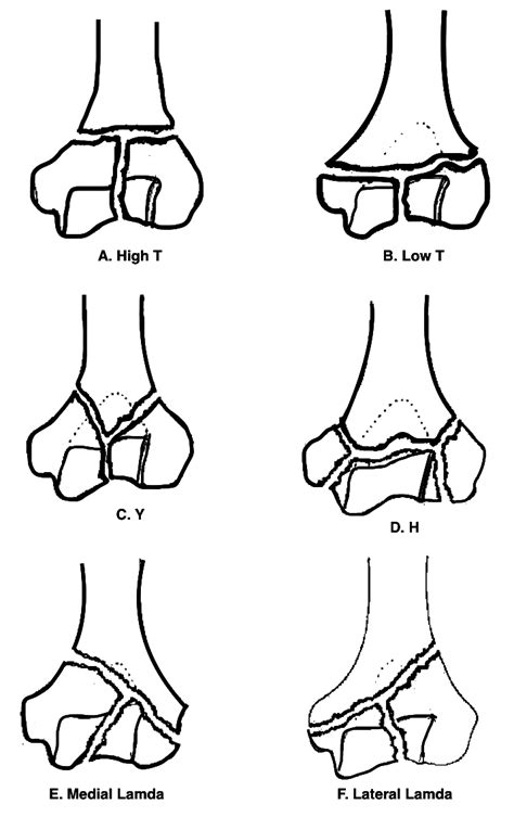 The Jupiter and Mehne classification of distal humerus fractures (From ...