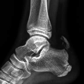 (PDF) Avulsion Fracture of Calcaneal Apophysis in an Adolescent Gymnast ...