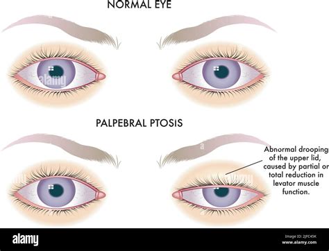 What Causes A Dog Lower Eyelid To Droop