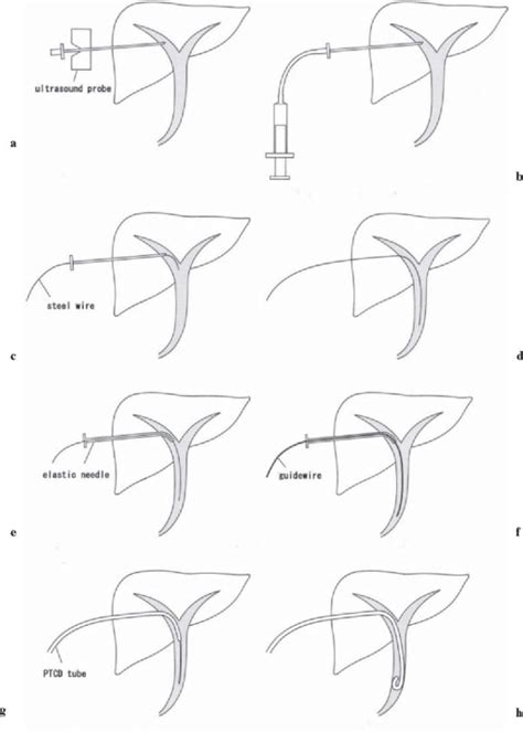 Percutaneous transhepatic cholangial drainage (PTCD or | Open-i