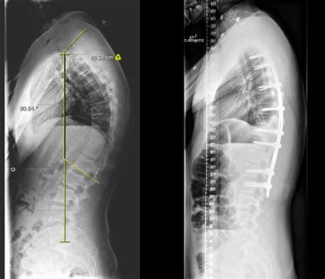 Kyphosis | Johns Hopkins Medicine