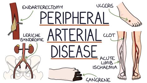 Understanding Peripheral Arterial Disease - YouTube