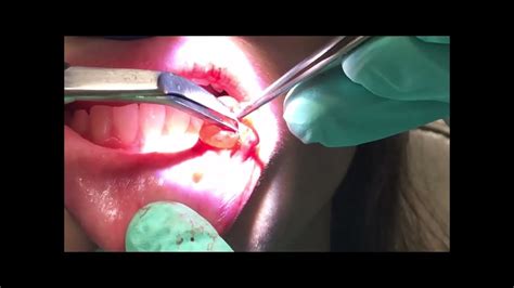 Surgical removal of mucocele from lower lip - YouTube