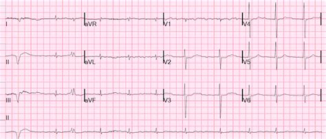 Dr. Smith's ECG Blog: Adding to the many faces of Hypokalemia....