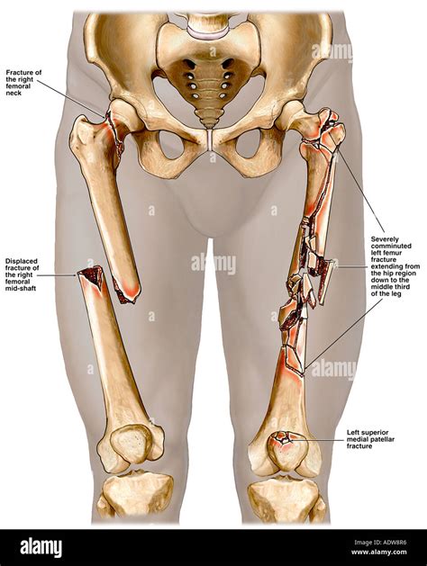 Displaced Compound Femur Fracture - Foto Kolekcija